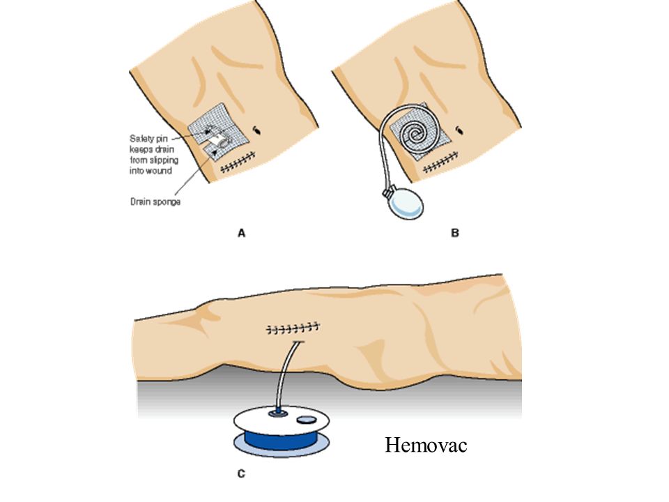 Constavac suction