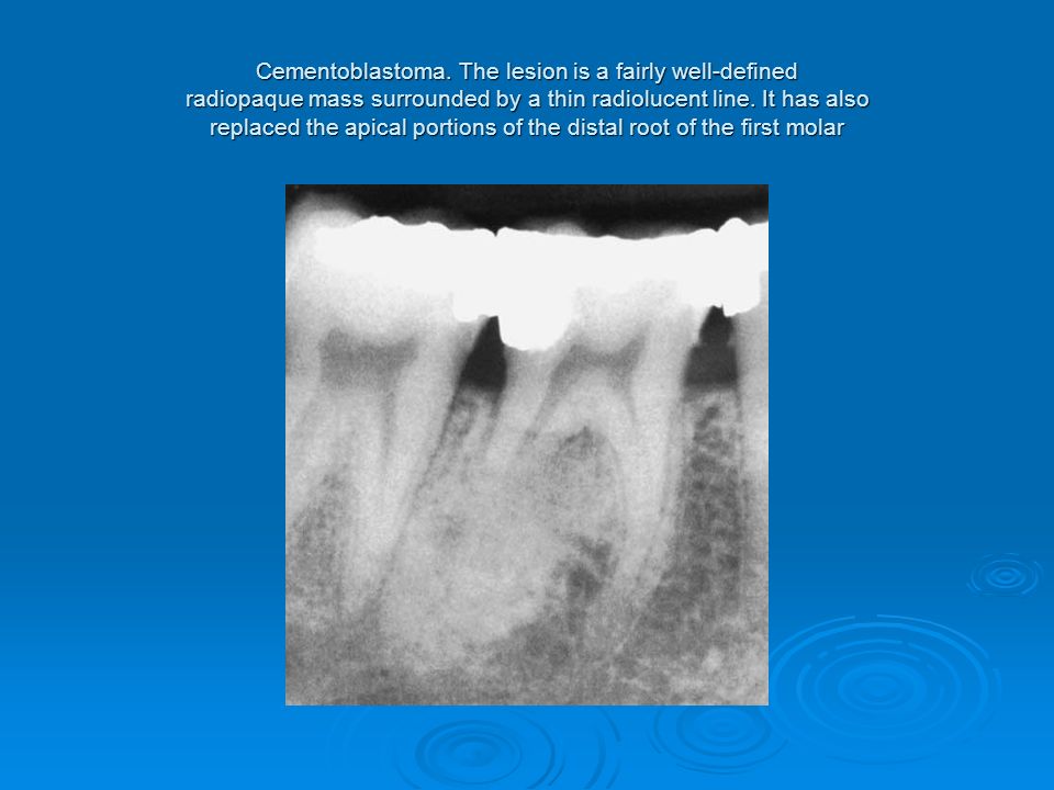 Bing: osteofibrosis treatment language:en