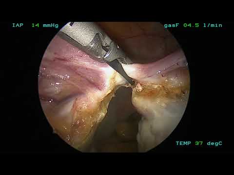 LAPAROSCOPIC HYSTEROPEXY - Oxford Gynaecology